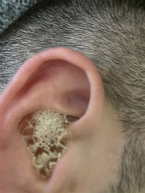 Blocked ear + Peroxide : r/earwax