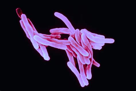 Tuberculosis Series: Intro - EthnoMed