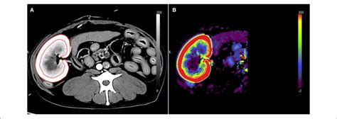 | Renal blood flow analysis using computed tomography perfusion images ...