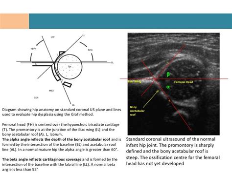 Anatomy - Hip Joint - Congenital hip dislocation ultrasound angles | Ultrasound, Hip flexor, Hip ...