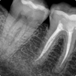 Periapical X-ray