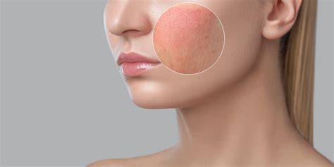 Skin Inflammation: The Ultimate Guide with Causes & Treatment