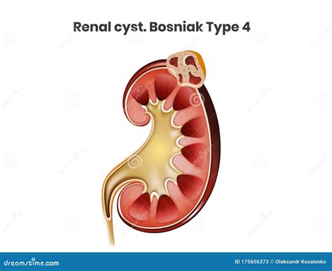 Renal Cyst, Bosniak Type 4. a Complex Cyst of the Kidney. Renal Cell Carcinoma Stock Vector ...