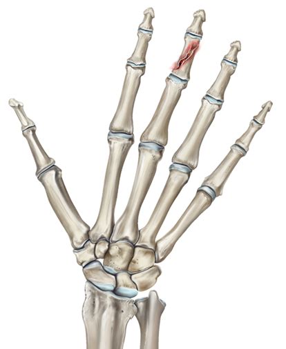 Middle Phalanx Fracture