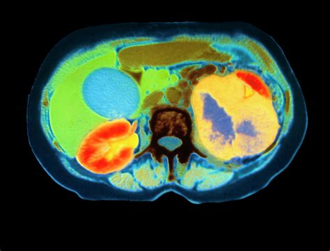 Col Ct Scan Showing Kidney Cancer (axial Section) Photograph by Dept. Of Clinical Radiology ...