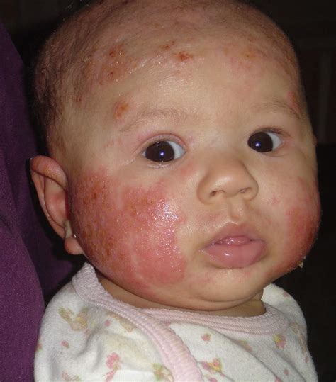 Baby Acne Cure and Treatment: Baby Eczema Pictures : What Looks Like Baby Eczema?