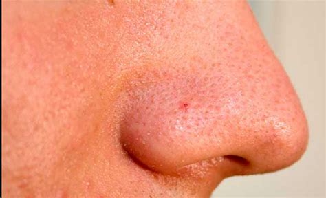 How To Reduce Large Open Pores on The Nose? - Best blackheadremoval Guide for your skin.