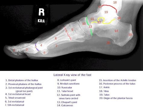 X-ray of the lateral foot | MyFootShop.com