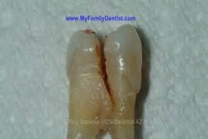 Cracked Tooth Symptoms- Sedona and Cottonwood Arizona- Highly Rated Dentist