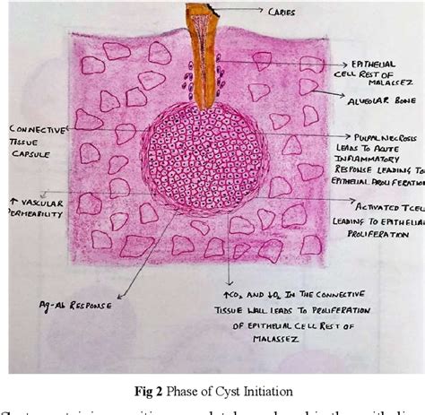 Radicular Cyst Histology