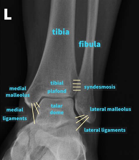 Ankle X-ray Interpretation | Ankle Fracture | Geeky Medics