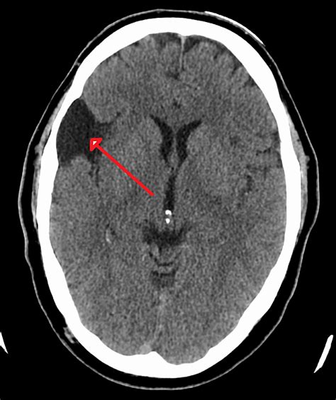 Arachnoid cyst - UF Health