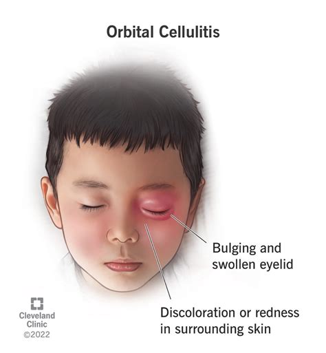 Orbital Cellulitis Symptoms Causes And Treatments | SexiezPicz Web Porn