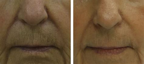 Lines and Wrinkles | Before & After | Kingsway Dermatology