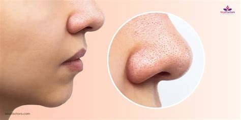 How To Shrink Pores On Nose: Pore-Fect Solutions!