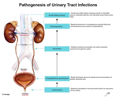 Pathophysiology Of Urinary Tract Infection Schematic Diagram