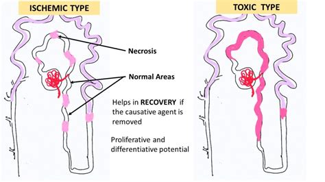 Pathology of Acute tubular injury/necrosis - Pathology Made Simple