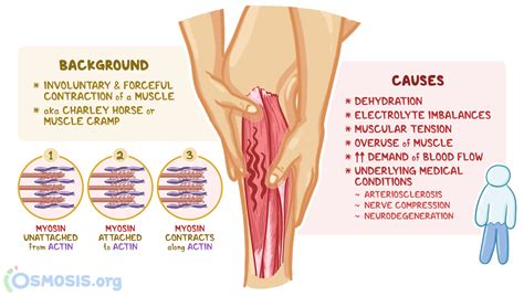 Muscle Spasms: What Are They, Causes, Diagnosis, and More | Osmosis