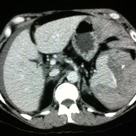 Coronal section CT scan of the abdomen revealing hemoperitoneum and a... | Download Scientific ...