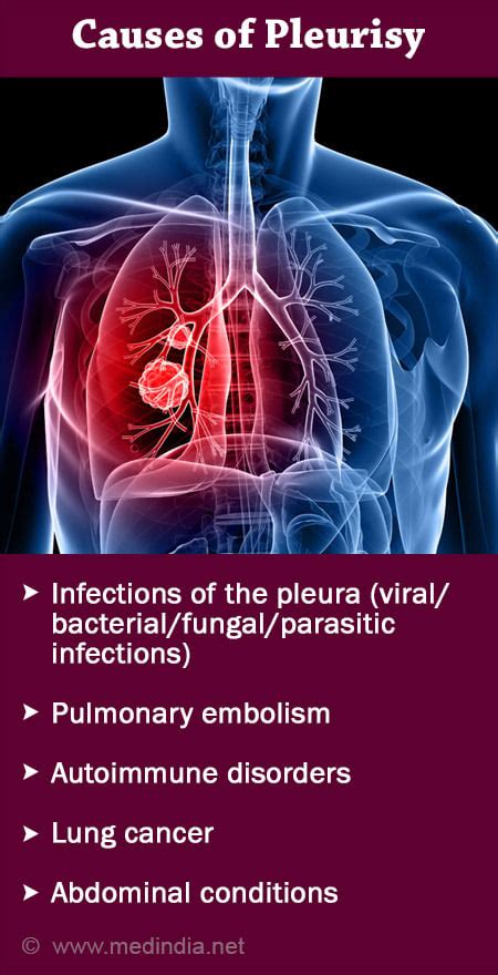 How To Detect Pleurisy - Respectprint22