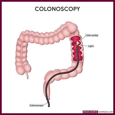 Colonoscopy - Nursing Responsibilities and Procedures - Nurseslabs