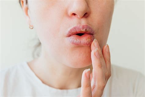 Why Does My Lip Swell When I Get A Cold Sore | Sitelip.org