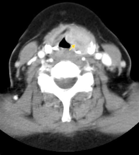 Laryngeal Cancer (Staging)