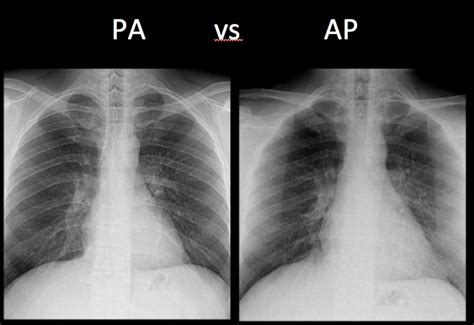 Chest X-Ray Basics: PA vs. AP - radRounds Radiology Network