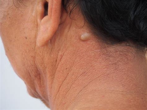 Lumps, Bumps, and Cysts: When to Seek Treatment: Clement Banda, MD: Dermatologist