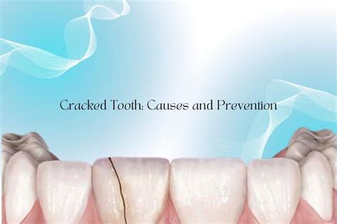 Crack Tooth: Causes And Prevention | My Smiles