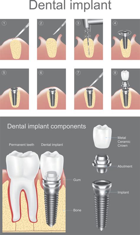 Dental Implants Process Palmdale | Dental Implant Steps