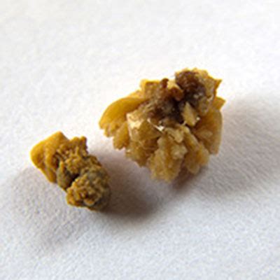 Kidney Calcium Oxalate Crystals & Stone Formation in Urine | Kidney C.O ...