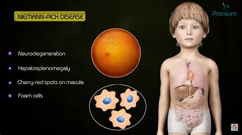 Lysosomal Storage Diseases : Quick review Medical biochemistry - YouTube