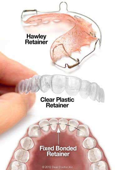 Types of Dental Retainers | Newmarket Dentists | Davis Dental Care