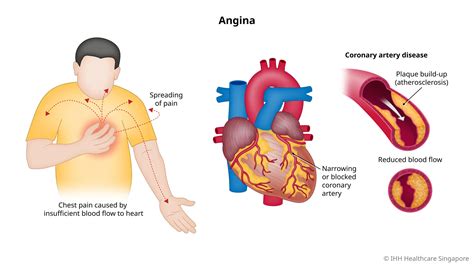 Chest Pain (Angina Pectoris) - Causes, Symptoms & Signs | Gleneagles Hospital