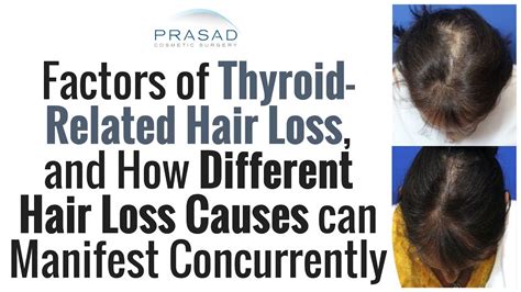 Thyroid And Hair Loss | Galhairs