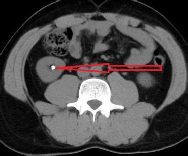 Diagnosis of Kidney Stones and Ureteral Stones - NYC Kidney Stone Clinic