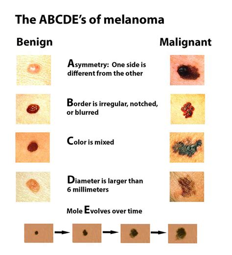 Can a New Melanoma Start Out Looking Like a Blackhead? — Scary Symptoms