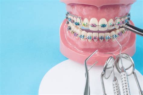 What To Do If Your Braces Have Broken - Healthicu