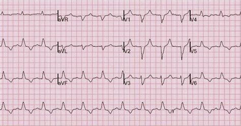 Dr. Smith's ECG Blog: Weakness, prolonged PR interval, wide complex, ventricular tachycardia