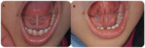 Sublingual Caruncle Swelling