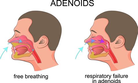 Adenoid Surgery (Adenoidectomy) - Dr. Jonathan Harounian