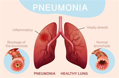 Pneumonia: Clinical Features, Treatment, and Complications ...