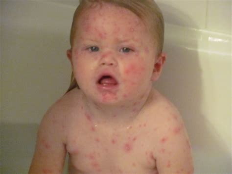 Chicken Pox | Chicken Pox Vaccine | Chicken Pox Pictures | Chicken Pox Symptoms | Diseases Pictures