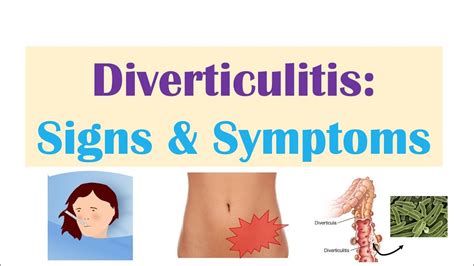 Diverticulitis Signs & Symptoms (And Why They Occur) - YouTube ...