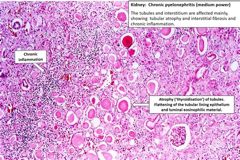 Chronic Pyelonephritis Histology