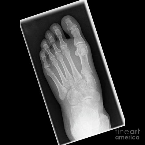 Fractured Metatarsal Foot Bones Photograph by Science Photo Library ...