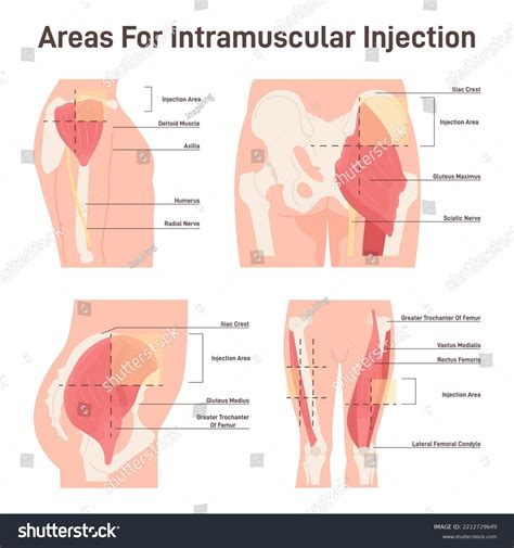 Intramuscular Injection: Definition And Patient Education, 48% OFF