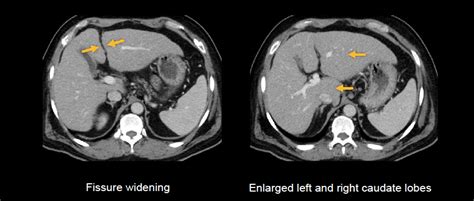 Abdominal CT: Liver • LITFL • Radiology library