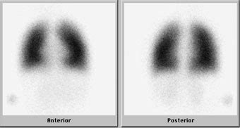 Ventilation-Perfusion Scan | Boston Children's Hospital